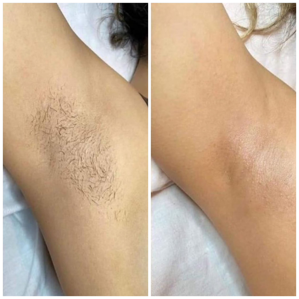 Деп.подмышек