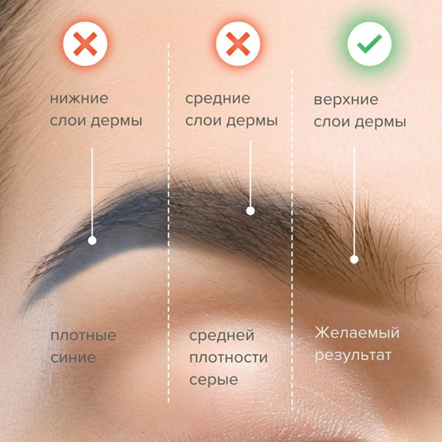 ПЕРЕКРЫТИЕ бровей после лазерного удаления