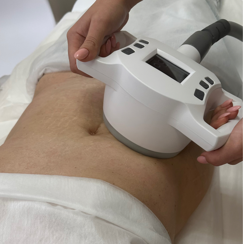 Ультразвуковая кавитация с вакуумом и RF лифтингом (разрушение жировой клетки с подтяжкой кожи) Инновационная технология на Аппарате Vela Shape v8c2