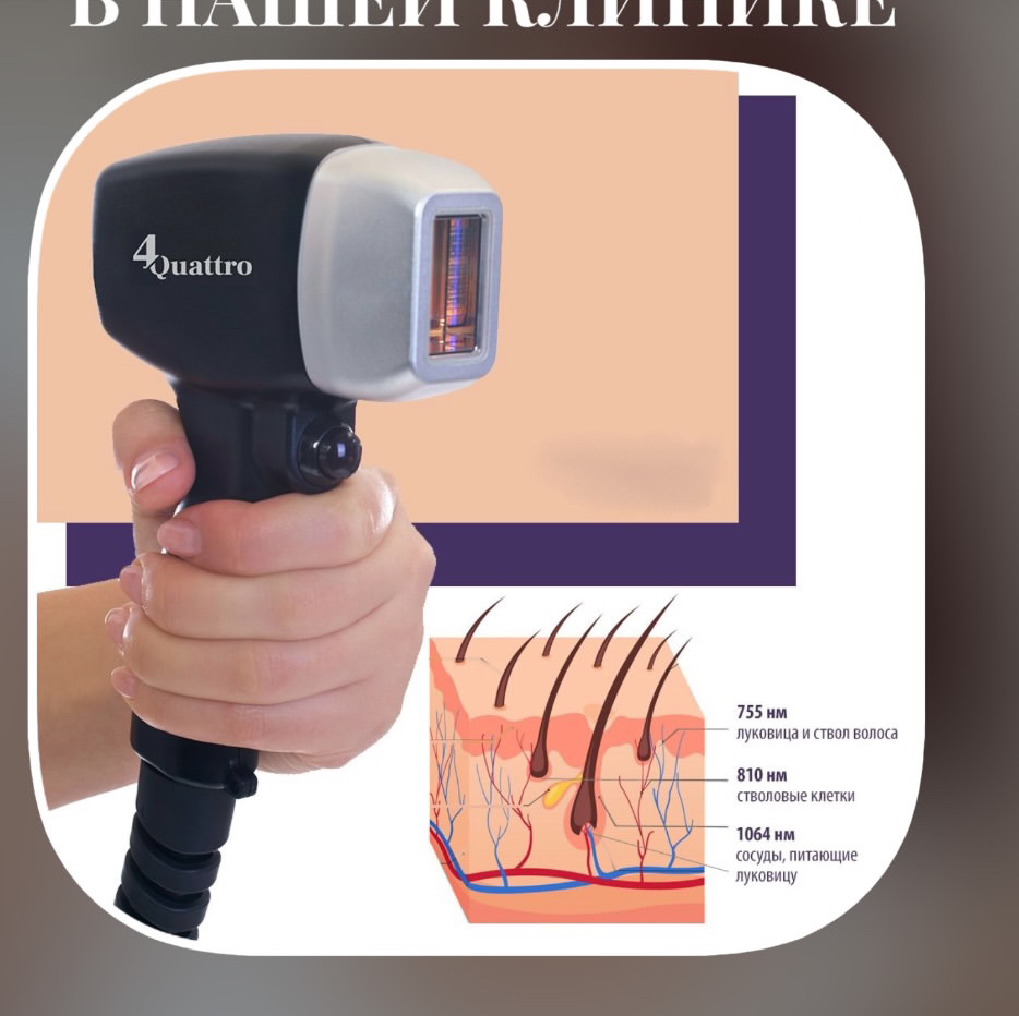 Лазерная эпиляция