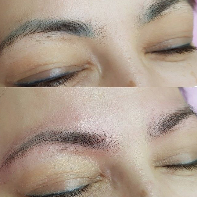 Удаление татуажа