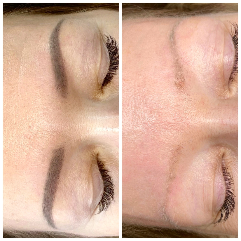 УДАЛЕНИЕ ЛАЗЕРОМ татуажа и пм. Удаление ремувером.