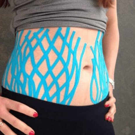 Нейролимфодренажный массаж живота с тейпированием