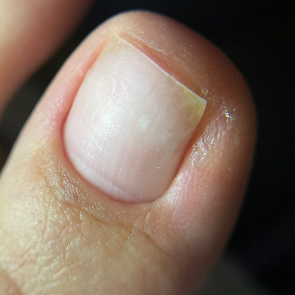 ➕Патологическое изменение ногтевой пластины/ Вросший ноготь/ Зачистка онихолизиса/ Установка тампонады