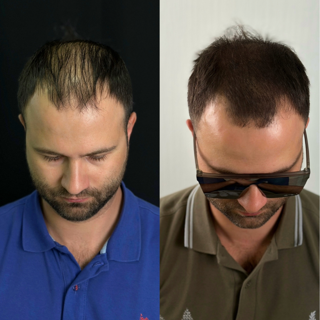 Загущение проплешин у мужчин