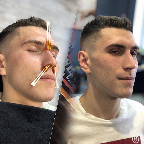 Удаление воском