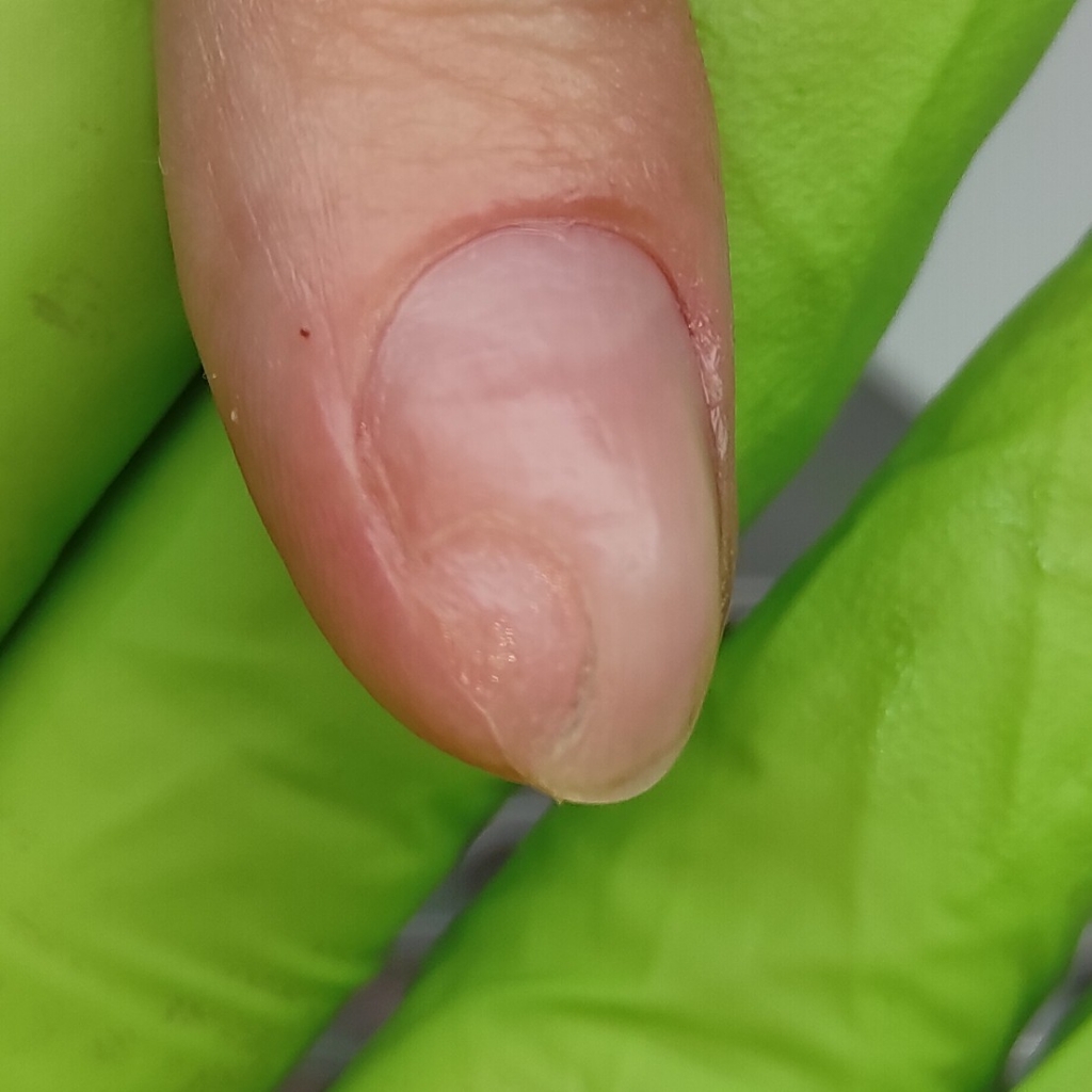 Обработка онихолизиса, онихогрифоза или микоза на руках 2-3 ногтя