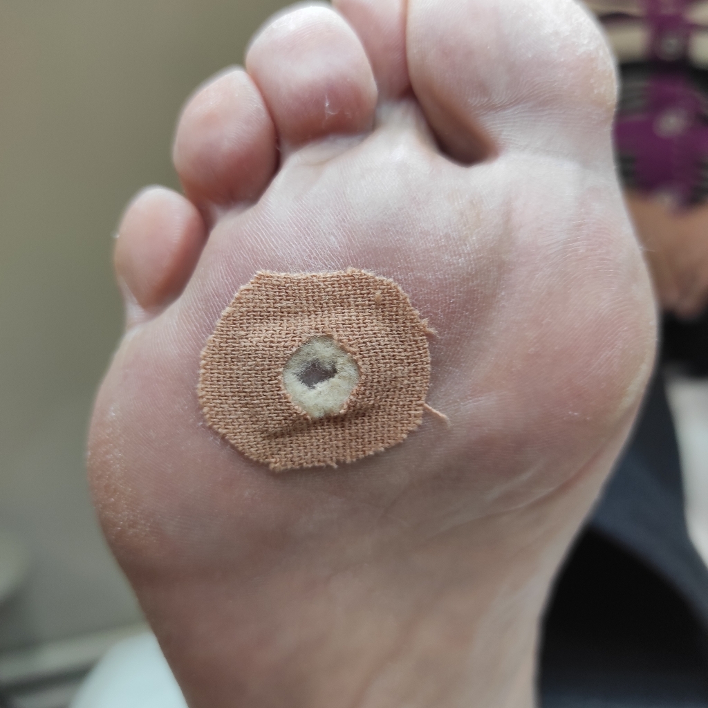 Обработка стержневой мозоли