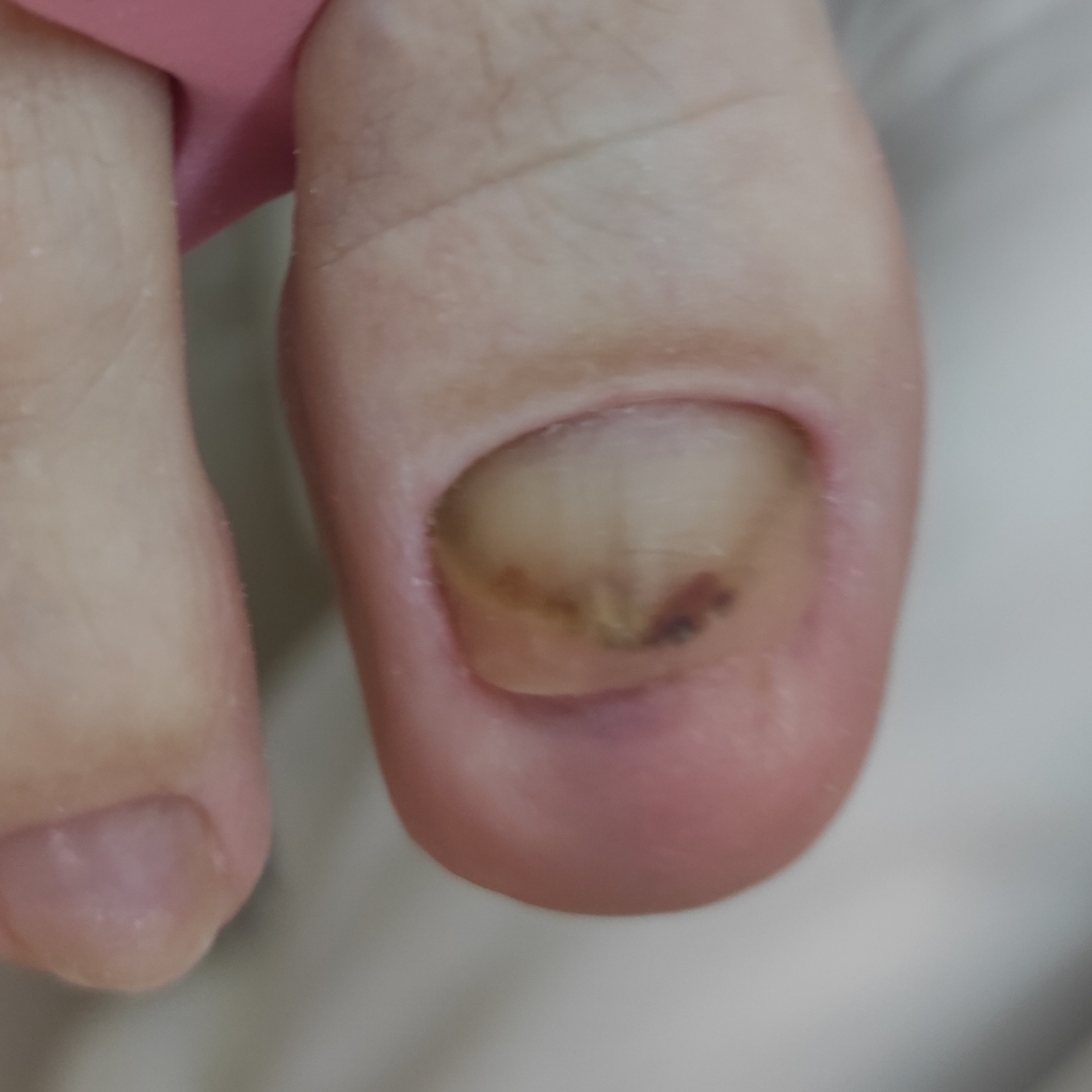 Протезирование ногтевой пластины на ногах (утрачено более 30%) 1 ноготь