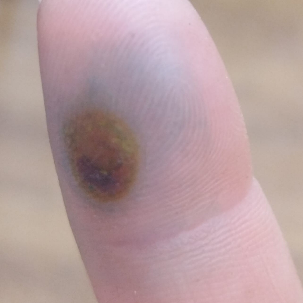 Обработка ладонных бородавок  от 4 до 10 шт