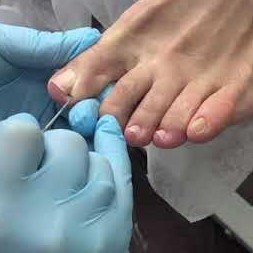 Обработка врастающего ногтя на ногах 2-4 ногтя