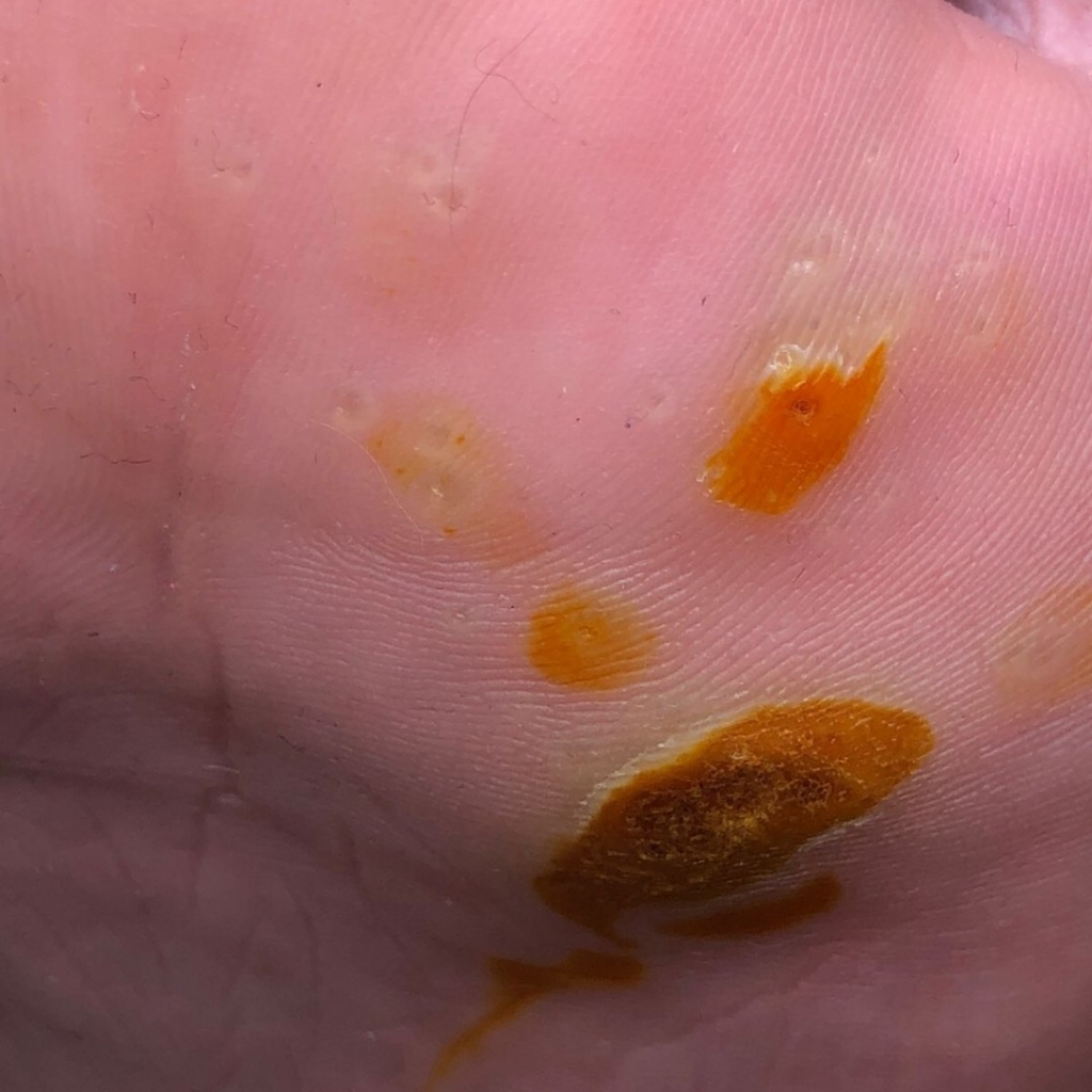 Обработка подошвенных бородавок от 4 до 10 штук