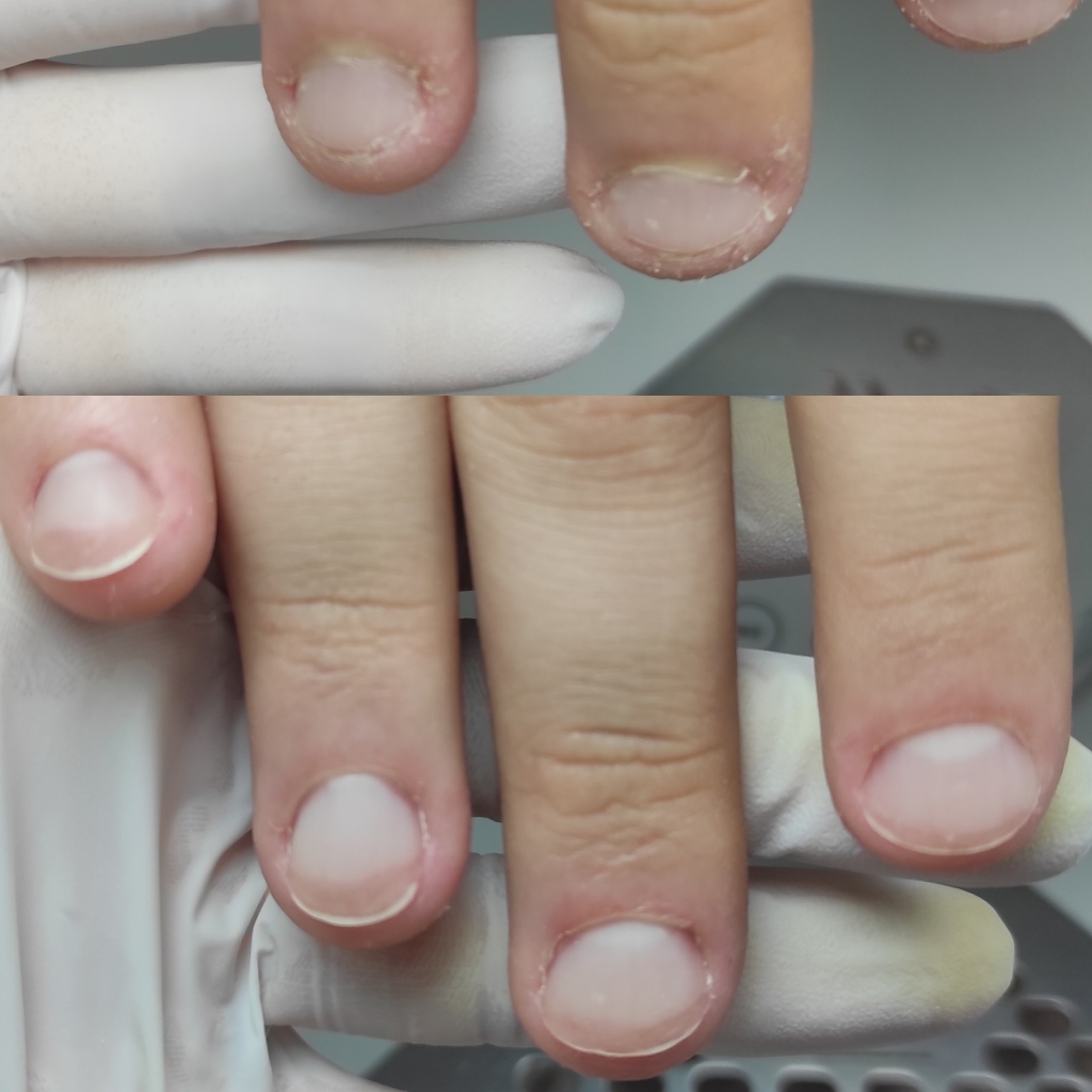 Протезирование ногтевой пластины на руках 7-10 ногтей
