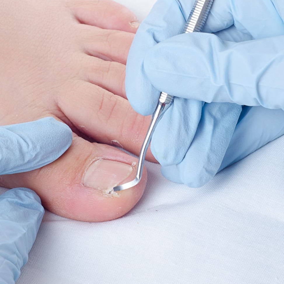 Обработка врастающего ногтя на ногах 1 ноготь