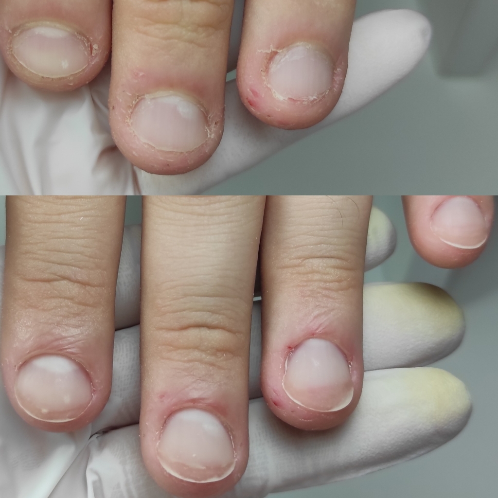 Протезирование ногтевой пластины на руках 4-6 ногтей