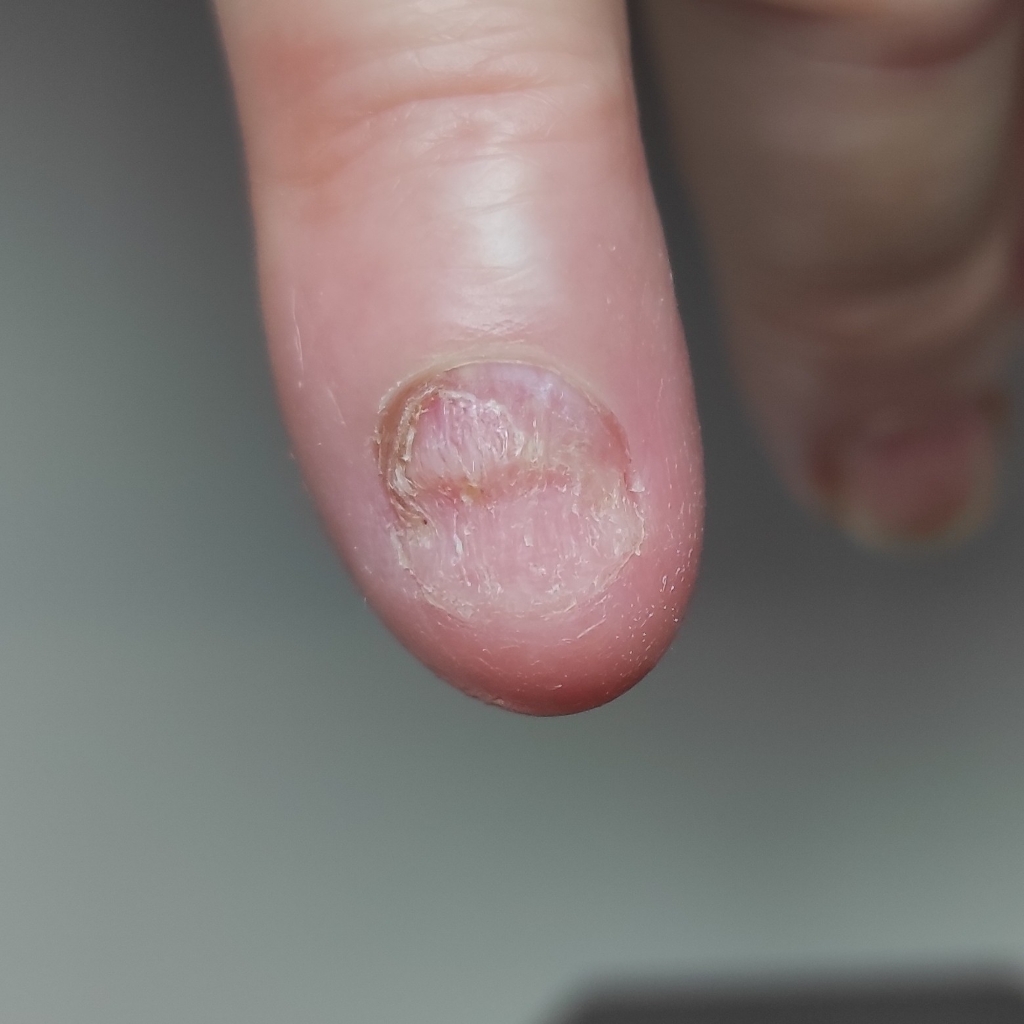 Обработка онихолизиса, онихогрифоза или микоза на руках 7-10 ногтей