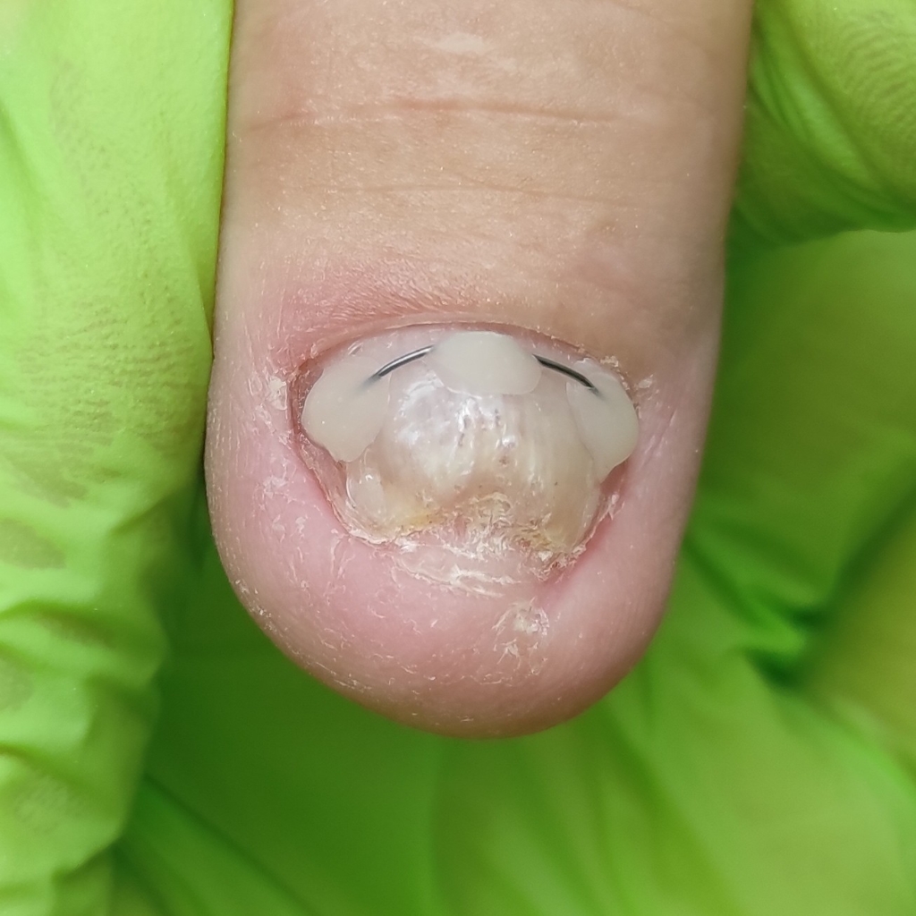 Установка титановой нити НА РУКАХ 1 ноготь