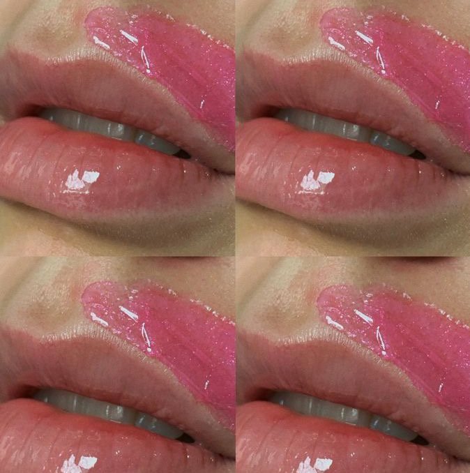 Удаление нежелательных волос на лице (одна зона)