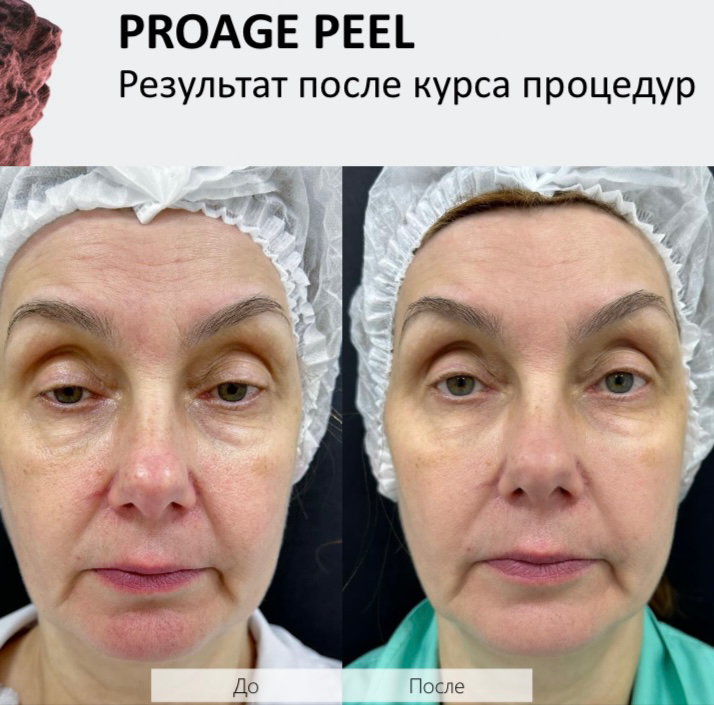 PROAGE PEEL.  Процедура сочетает действие мультикислотного омолаживающего пилинга, карбокситерапии и экзопротекции. Mesaltera (Россия- Швейцария)