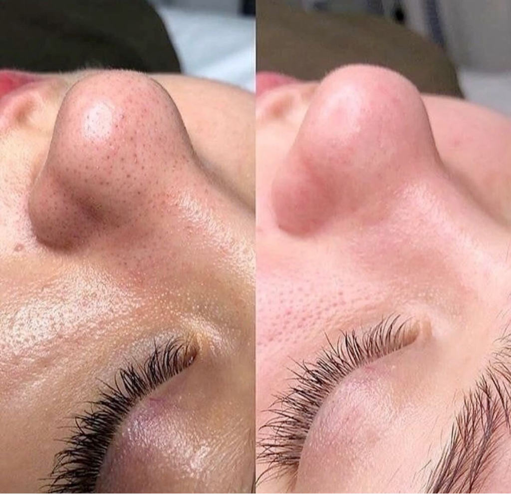 Вариабельная чистка лица. Методика очищения кожи лица сочетанная с различными техниками, аппаратами и пилингами по типу и проблеме кожи.