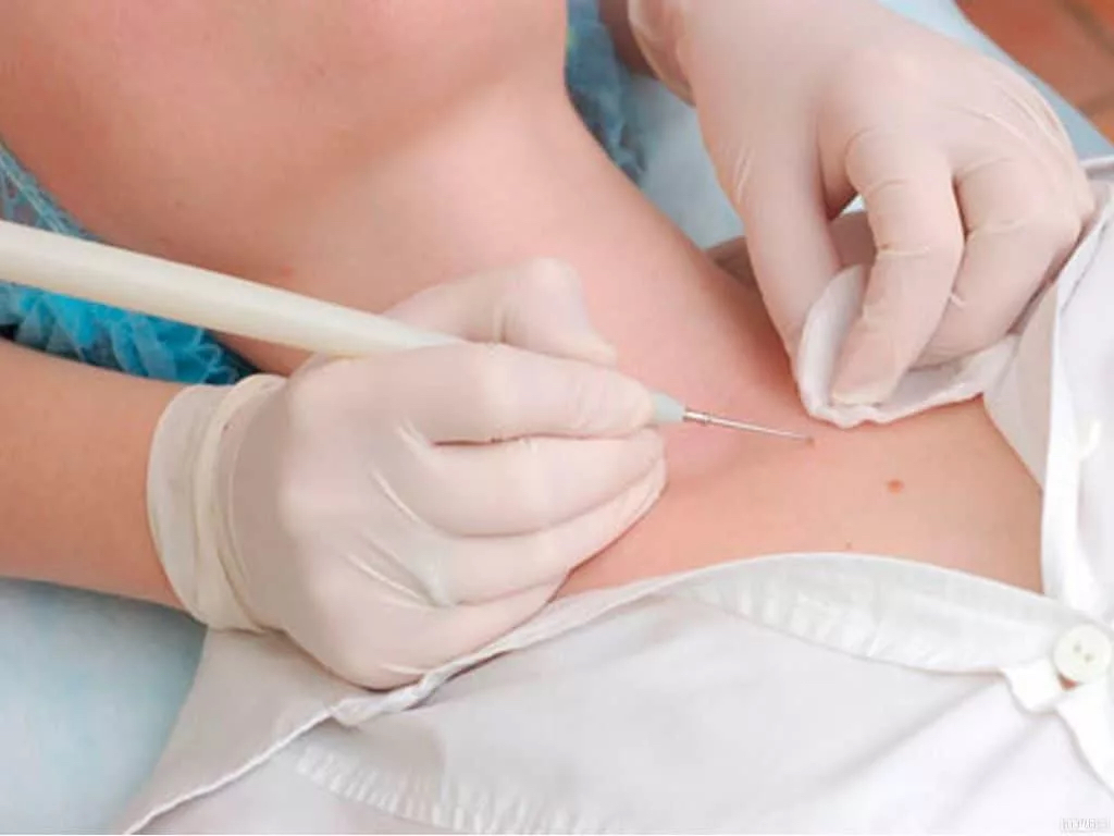 Удаление папиллом