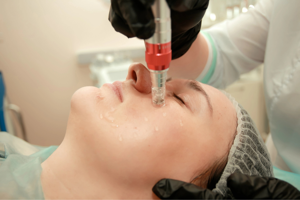 Янтарное омоложение. Процедура сочетанная с фракционной мезотерапией, направленная на мощное увлажнение, антивозрастное, осветляющее действие.