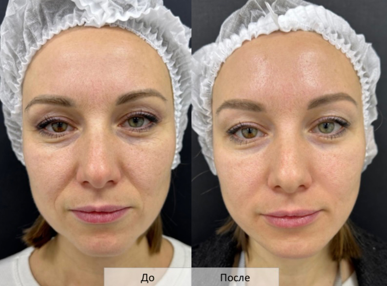 Гидролифтинг. Инъекционный биорепарирующий лифтинг по точкам. Процедура на выход. РУ ФСР 2010/06572