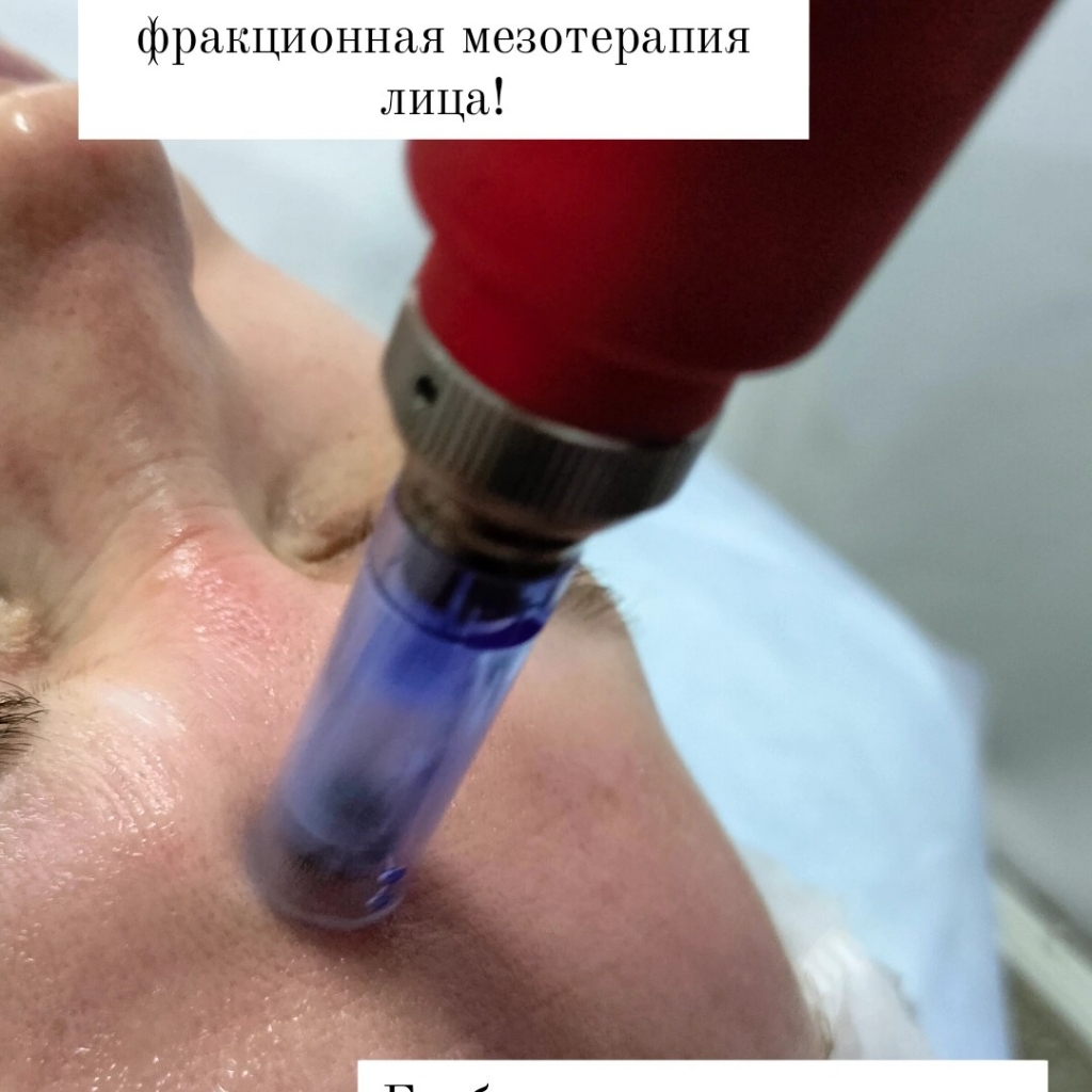 Фракционная мезотерапия лица