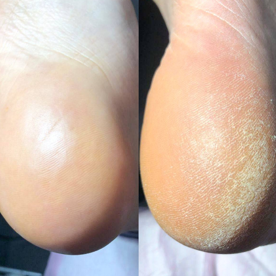 Гигиенический Smart педикюр