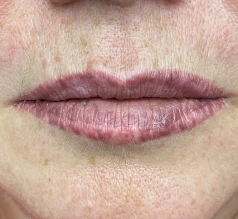 Удаления татуажа ремувером