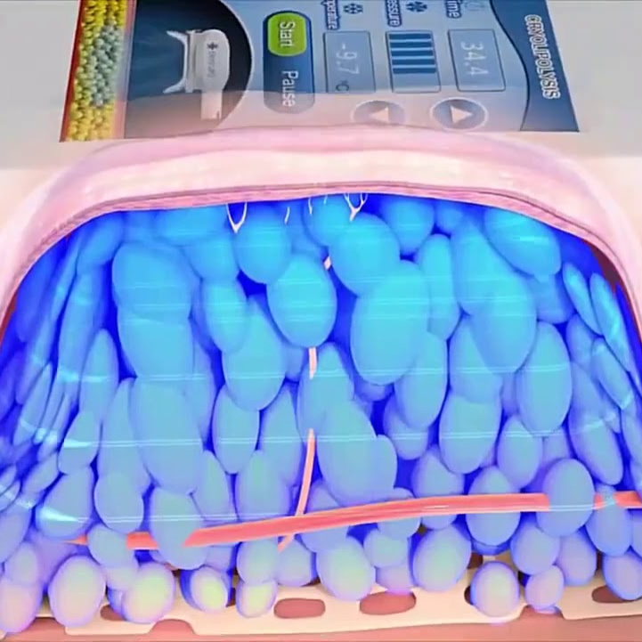 Криолиполиз (1 зона)