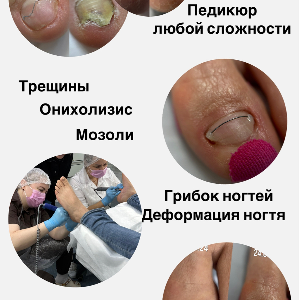 Комплексная обработка стоп и ногтей, 1 степень сложности
