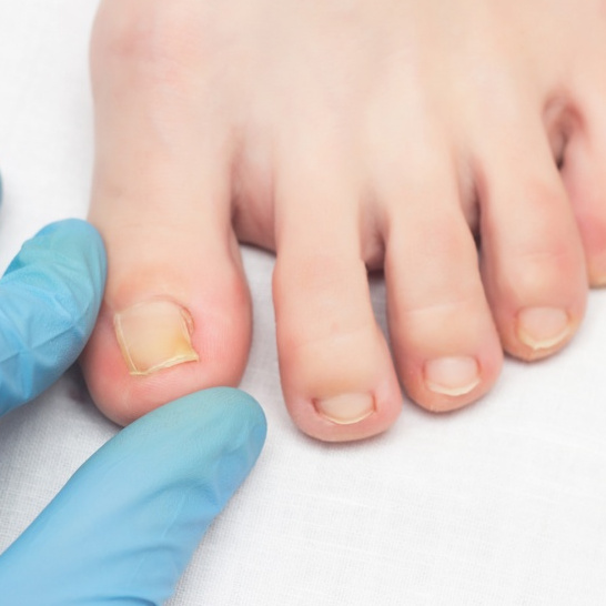 Обработка боковой стенки вросшего ногтя