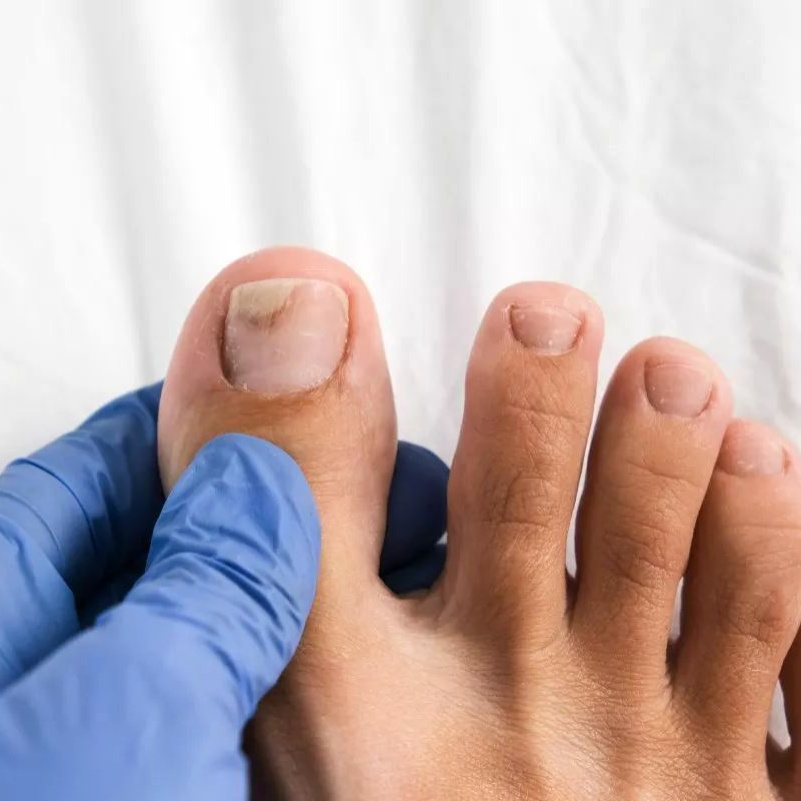 Зачистка онихолизиса