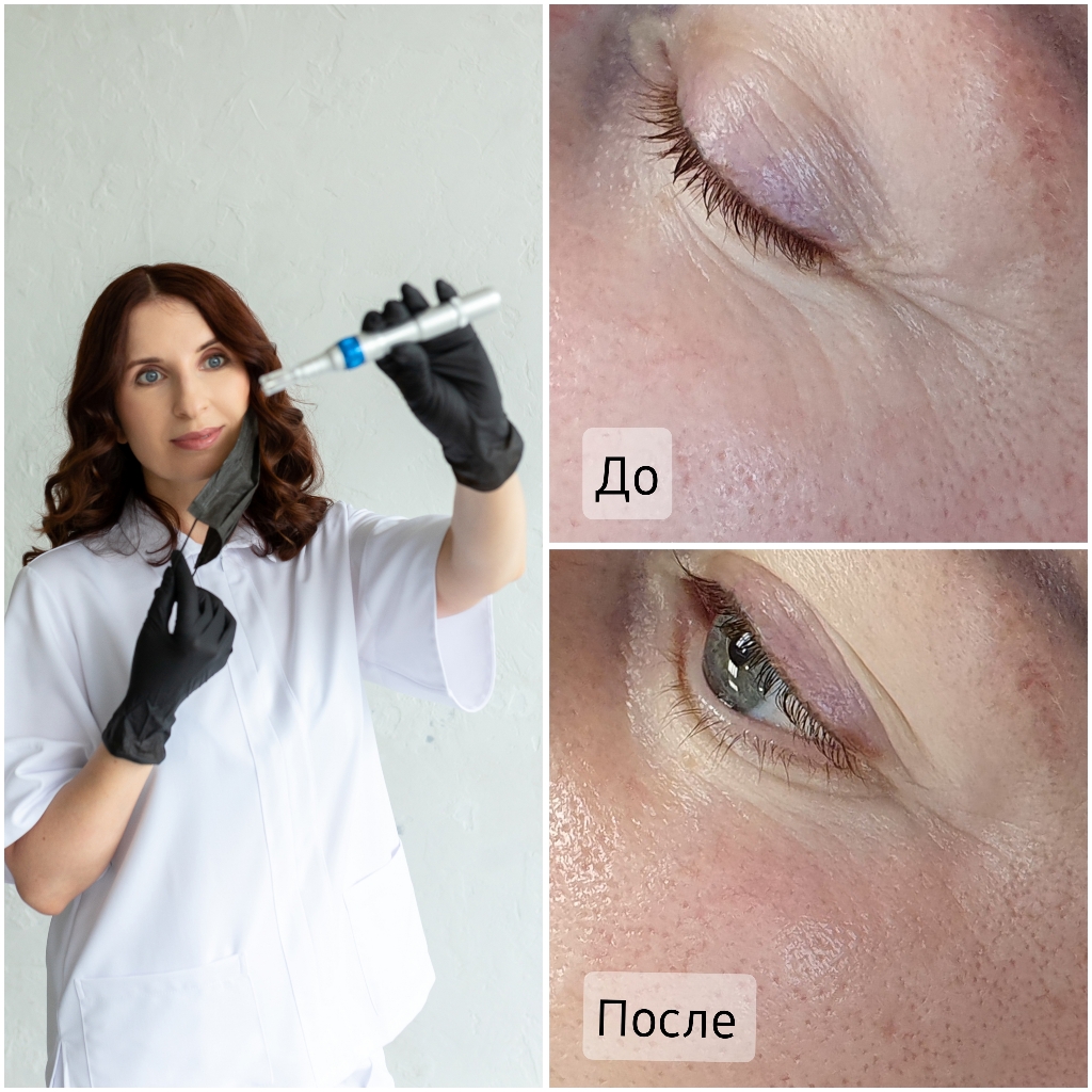 Люкс-уход "Коллагеновая роскошь" (Микронидлинг)