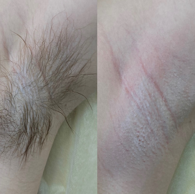 Шугаринг зоны Подмышечные впадины