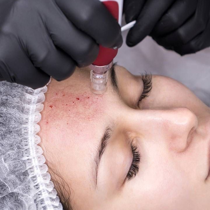 Микронидлинг депигментирующий