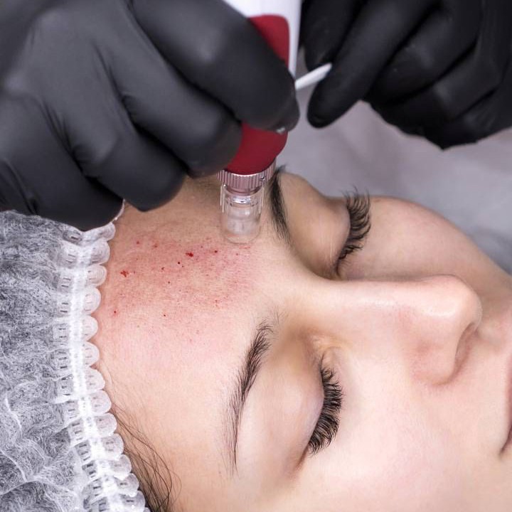 Микронидлинг(альтернативная ботулинотерапия)