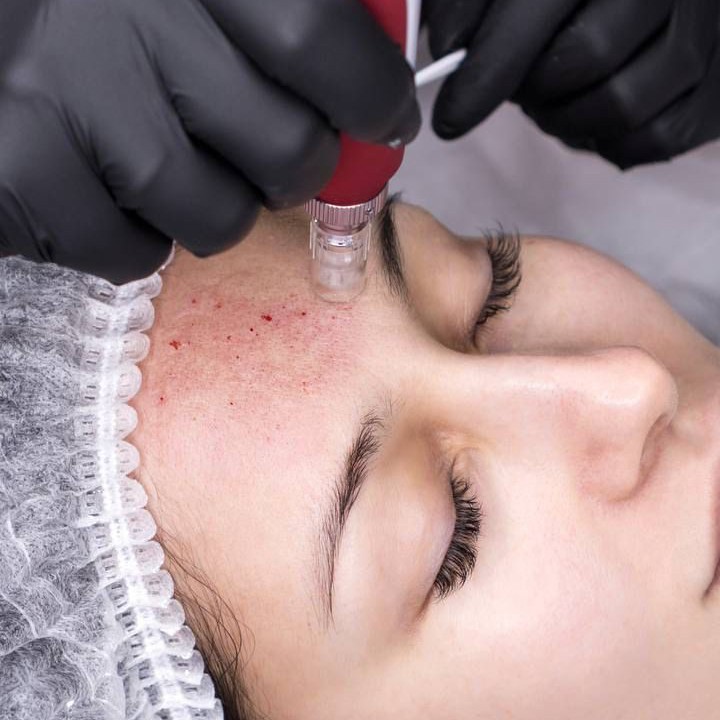 Микронидлинг(9пептидов)+нано золото