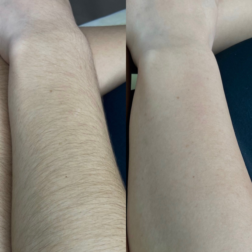 Шугаринг зоны Ручки