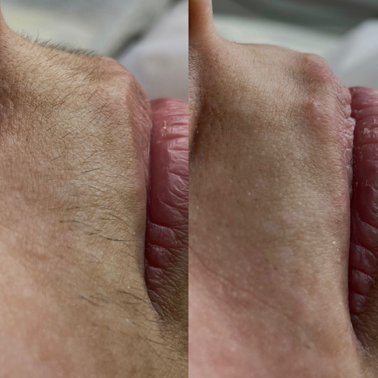 Шугаринг зоны Усики