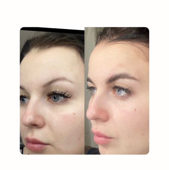 Аппаратное восстановление бровей