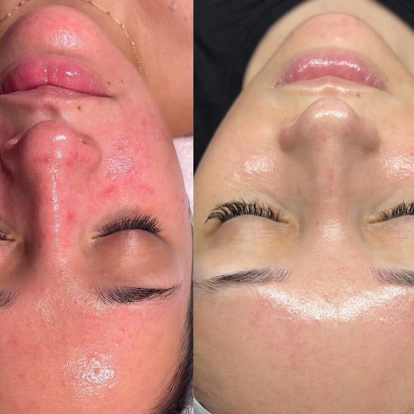 Пилинг коралловый