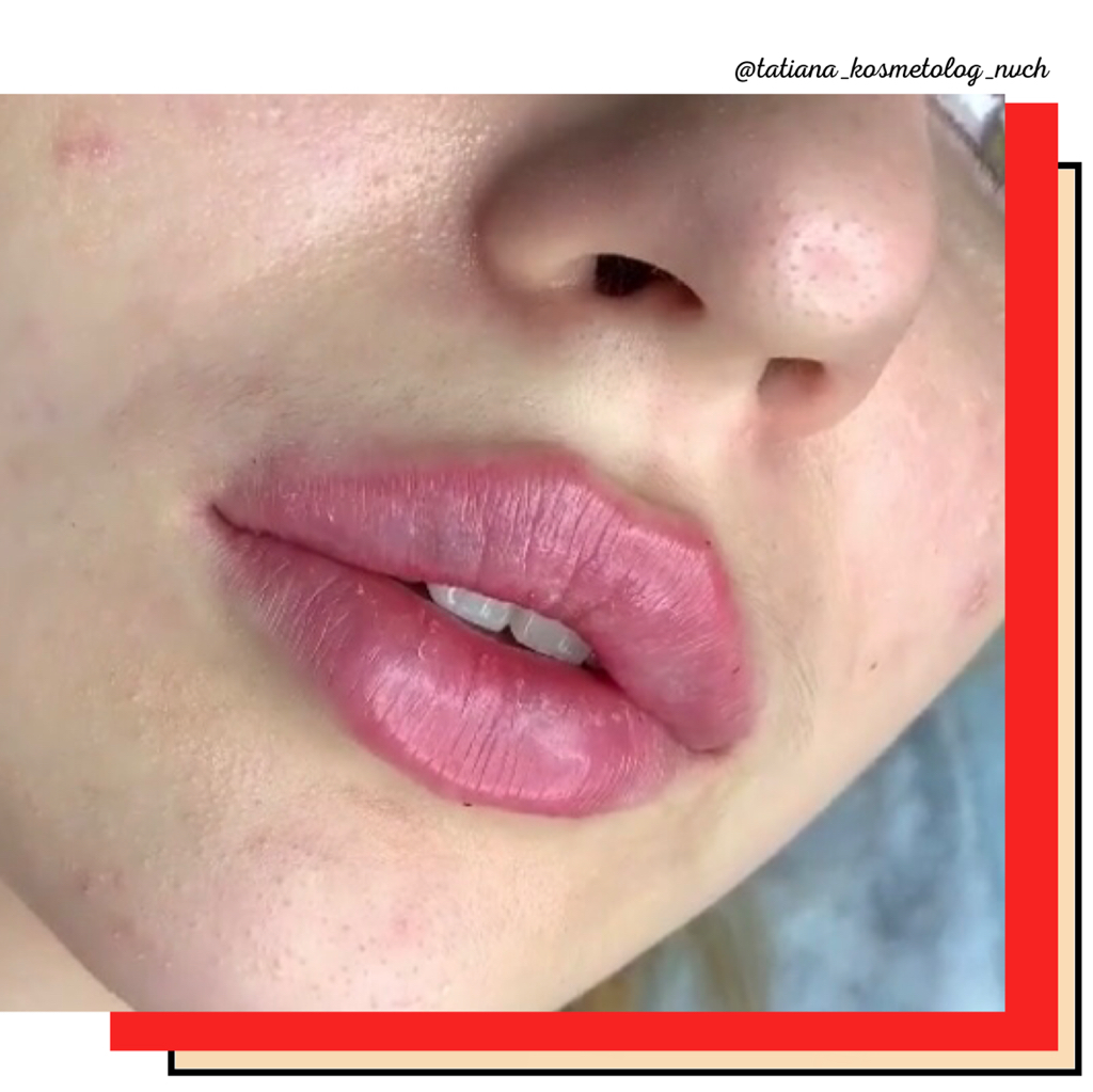 Аугментация (увеличение) губ
