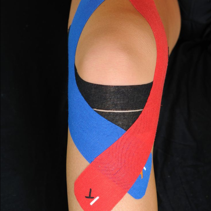 Тейпирование суставов (травма, отёк, перелом, растяжение, артроз)