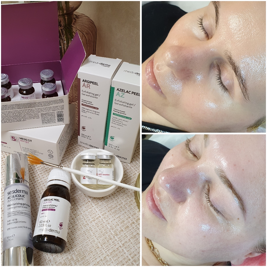 Волшебное обновление. Поверхностно-срединный пилинг