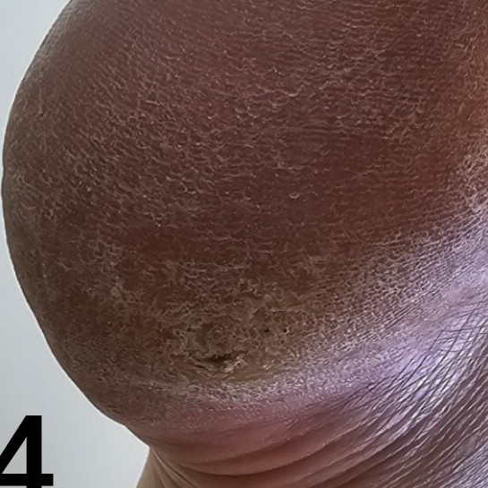 Педикюр сложных стоп (Трещины,гиперкератоз)