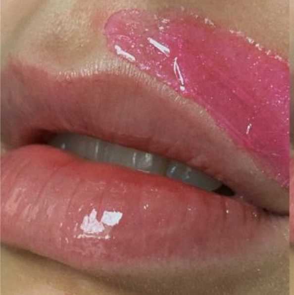 Удаление нежелательных волос на лице