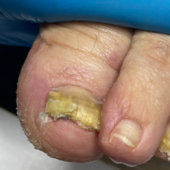 обработка грибка 1 ноготь✔