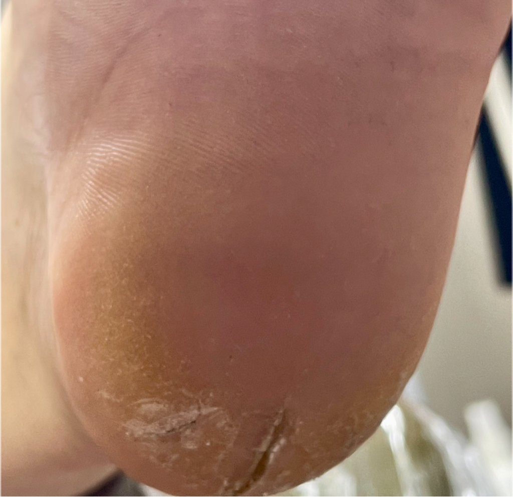 обработка трещин(не глубокие)